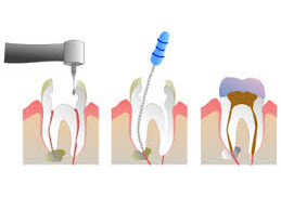 Endodontie
