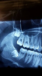 molar inclus